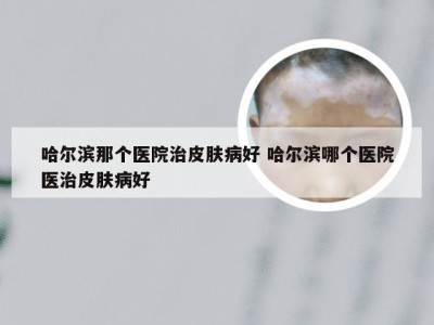 哈尔滨那个医院治皮肤病好 哈尔滨哪个医院医治皮肤病好