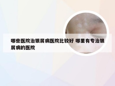 哪些医院治银屑病医院比较好 哪里有专治银屑病的医院