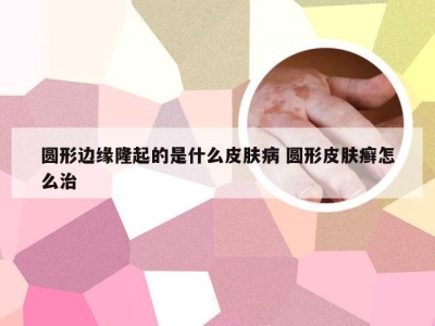 圆形边缘隆起的是什么皮肤病 圆形皮肤癣怎么治