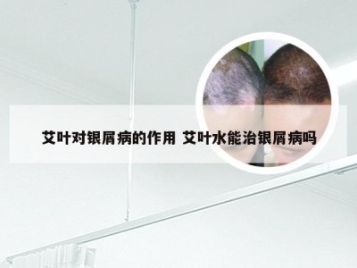 艾叶对银屑病的作用 艾叶水能治银屑病吗