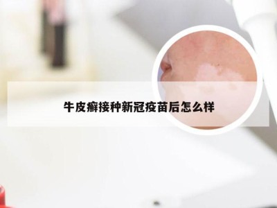 牛皮癣接种新冠疫苗后怎么样