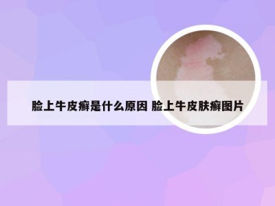 脸上牛皮癣是什么原因 脸上牛皮肤癣图片