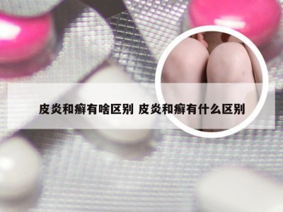 皮炎和癣有啥区别 皮炎和癣有什么区别