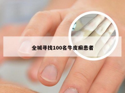 全城寻找100名牛皮癣患者