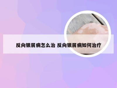 反向银屑病怎么治 反向银屑病如何治疗