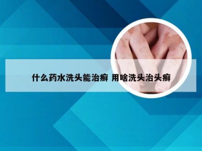 什么药水洗头能治癣 用啥洗头治头癣