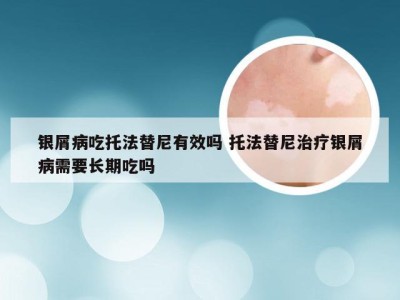 银屑病吃托法替尼有效吗 托法替尼治疗银屑病需要长期吃吗