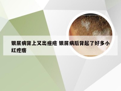 银屑病背上又出痤疮 银屑病后背起了好多小红疙瘩