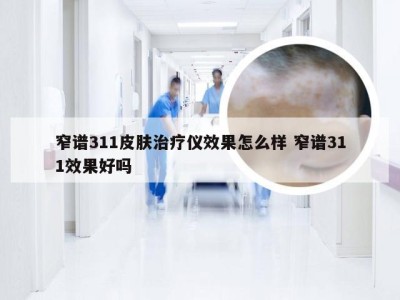 窄谱311皮肤治疗仪效果怎么样 窄谱311效果好吗