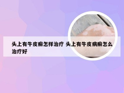 头上有牛皮癣怎样治疗 头上有牛皮病癣怎么治疗好