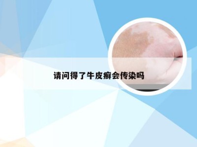 请问得了牛皮癣会传染吗