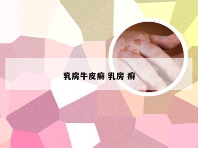 乳房牛皮癣 乳房 癣