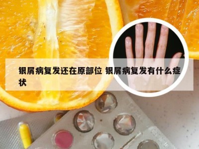 银屑病复发还在原部位 银屑病复发有什么症状