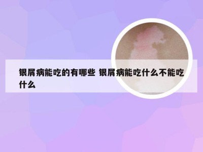 银屑病能吃的有哪些 银屑病能吃什么不能吃什么