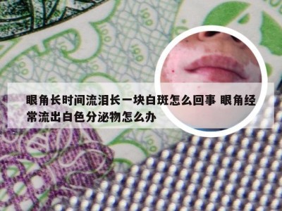 眼角长时间流泪长一块白斑怎么回事 眼角经常流出白色分泌物怎么办