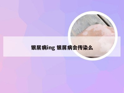 银屑病ing 银屑病会传染么