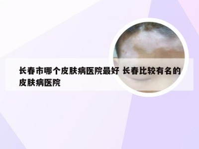 长春市哪个皮肤病医院最好 长春比较有名的皮肤病医院