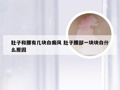 肚子和腰有几块白癜风 肚子腰部一块块白什么原因