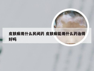 皮肤癣用什么民间药 皮肤癣能用什么药治得好吗