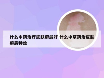 什么中药治疗皮肤癣最好 什么中草药治皮肤癣最特效