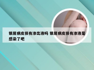 银屑病皮损有渗出液吗 银屑病皮损有渗液是感染了吧