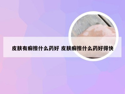 皮肤有癣擦什么药好 皮肤癣擦什么药好得快