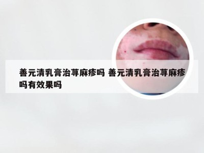 善元清乳膏治荨麻疹吗 善元清乳膏治荨麻疹吗有效果吗