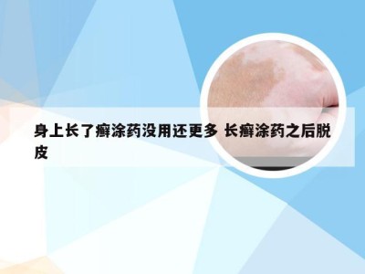 身上长了癣涂药没用还更多 长癣涂药之后脱皮