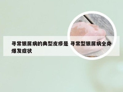 寻常银屑病的典型皮疹是 寻常型银屑病全身爆发症状