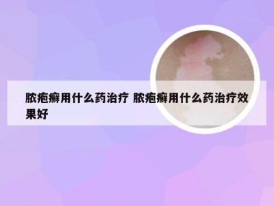 脓疱癣用什么药治疗 脓疱癣用什么药治疗效果好