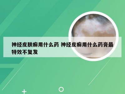 神经皮肤癣用什么药 神经皮癣用什么药膏最特效不复发