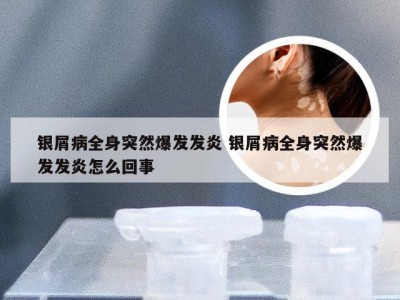 银屑病全身突然爆发发炎 银屑病全身突然爆发发炎怎么回事