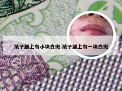 孩子腿上有小块白斑 孩子腿上有一块白斑