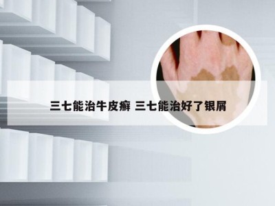 三七能治牛皮癣 三七能治好了银屑