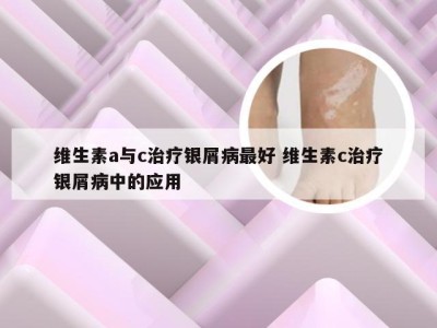 维生素a与c治疗银屑病最好 维生素c治疗银屑病中的应用