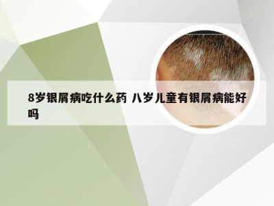 8岁银屑病吃什么药 八岁儿童有银屑病能好吗