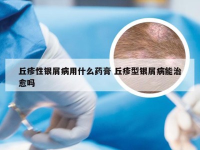 丘疹性银屑病用什么药膏 丘疹型银屑病能治愈吗