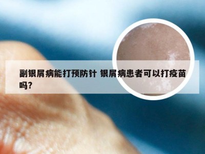 副银屑病能打预防针 银屑病患者可以打疫苗吗?