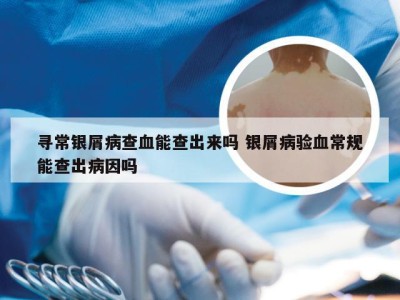 寻常银屑病查血能查出来吗 银屑病验血常规能查出病因吗