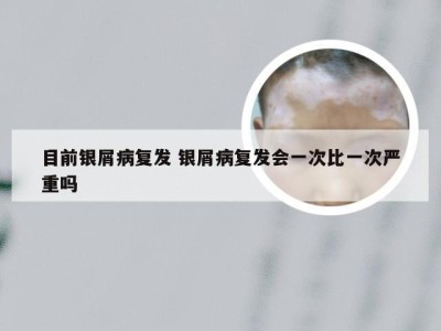 目前银屑病复发 银屑病复发会一次比一次严重吗