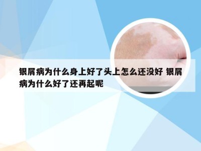 银屑病为什么身上好了头上怎么还没好 银屑病为什么好了还再起呢