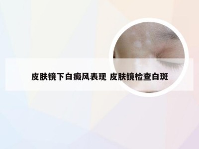 皮肤镜下白癜风表现 皮肤镜检查白斑