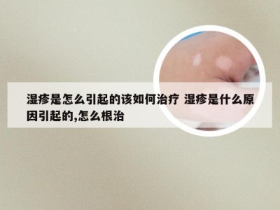 湿疹是怎么引起的该如何治疗 湿疹是什么原因引起的,怎么根治