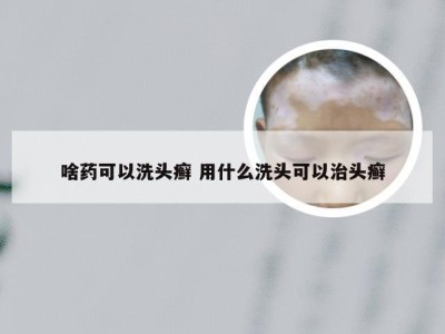 啥药可以洗头癣 用什么洗头可以治头癣