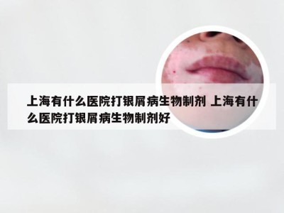 上海有什么医院打银屑病生物制剂 上海有什么医院打银屑病生物制剂好