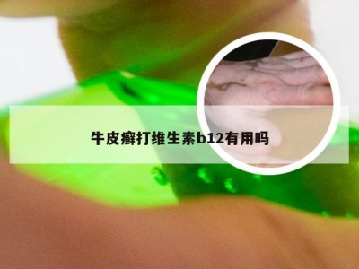 牛皮癣打维生素b12有用吗