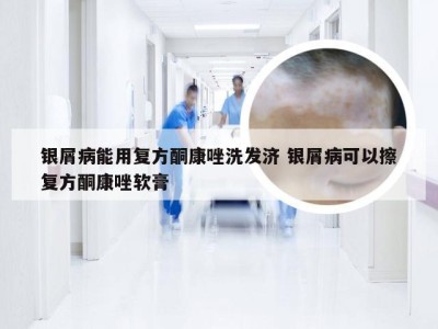 银屑病能用复方酮康唑洗发济 银屑病可以擦复方酮康唑软膏