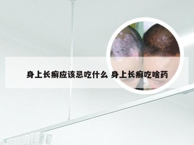 身上长癣应该忌吃什么 身上长癣吃啥药