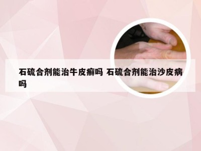 石硫合剂能治牛皮癣吗 石硫合剂能治沙皮病吗