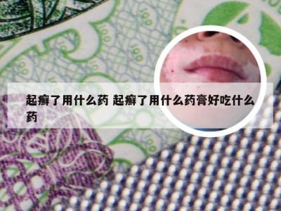 起癣了用什么药 起癣了用什么药膏好吃什么药